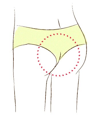 Q:はいているうちにショーツがくいこんできて、はみ肉になってしまう