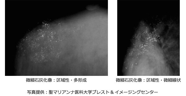 化 マンモグラフィー 石灰