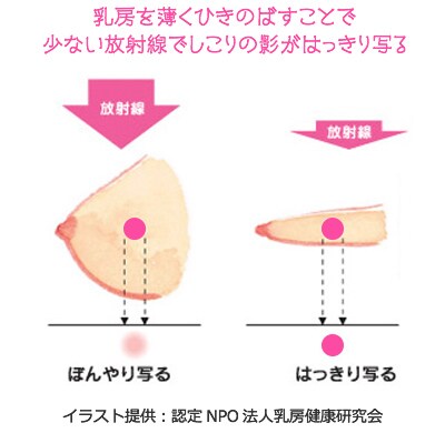 マンモグラフィやデンスブレスト 高濃度乳房 について福田護先生に聞きました ワコールピンクリボン活動